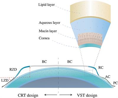 Does <mark class="highlighted">Orthokeratology</mark> Wearing Affect the Tear Quality of Children?